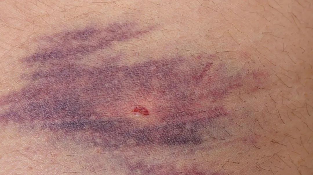 起病急，不明原因發(fā)熱，已有人中招……